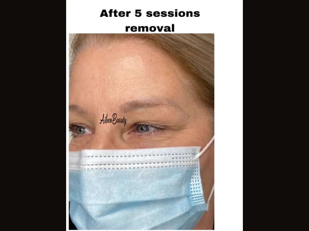 The same client after non-laser eyebrow tattoo removal at Aileen's Beauty — ashy / cool pigment visibly lifted