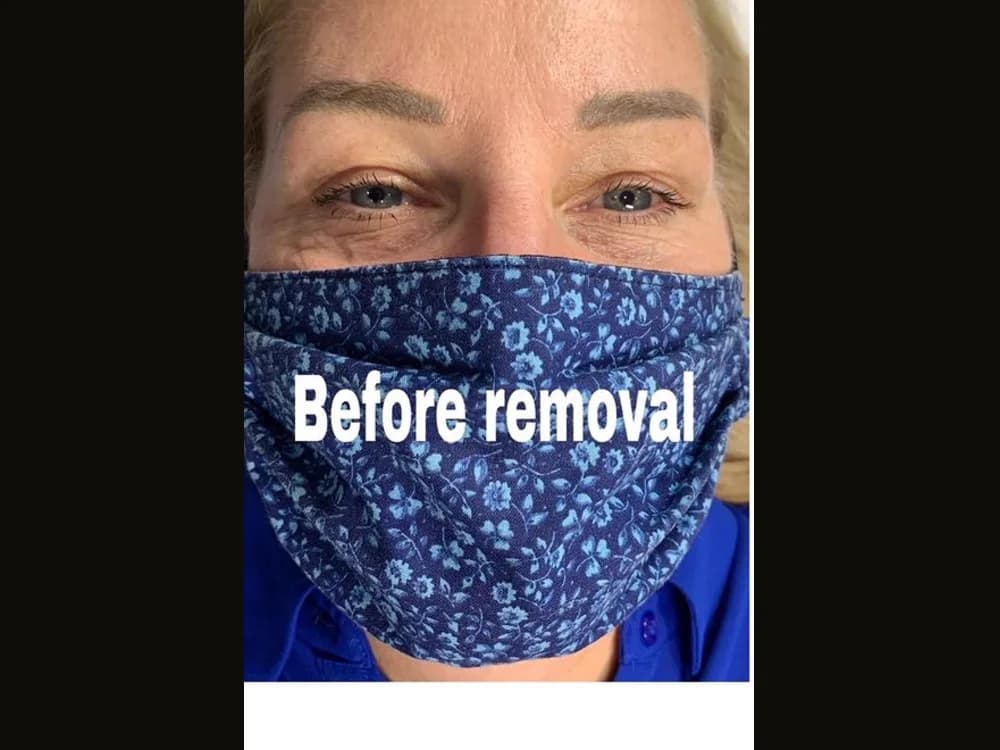 Faded cool-toned brow tattoo — Before removal · front (real client, unretouched)