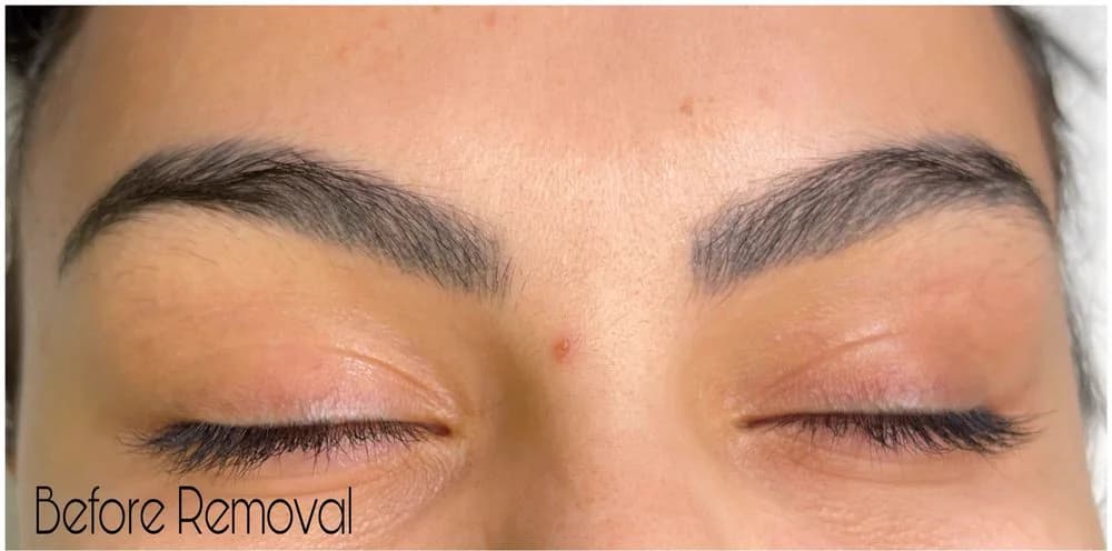 Dark ashy brow tattoo before non-laser removal — dark / ashy pigment (real client)