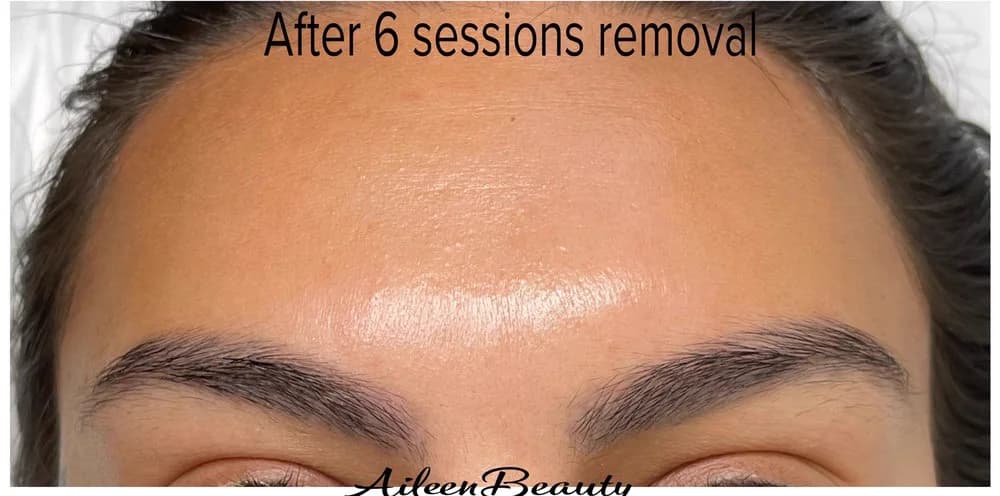 The same client after non-laser eyebrow tattoo removal at Aileen's Beauty — dark / dense pigment visibly lifted