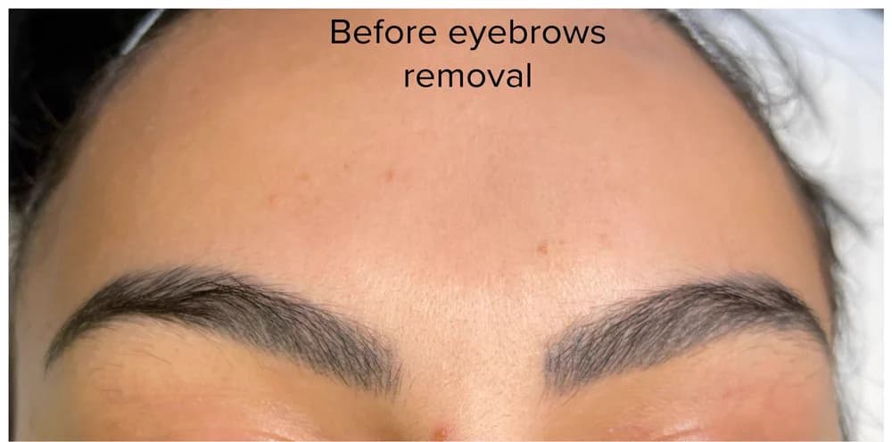 Real client with dark / dense dark saturated brow tattoo before non-laser eyebrow tattoo removal at Aileen's Beauty in Campbell, California