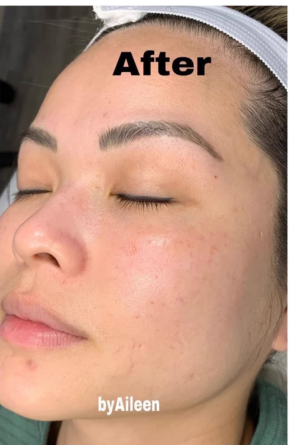 The same client after facial treatments at Aileen's Beauty — clearer, more radiant skin