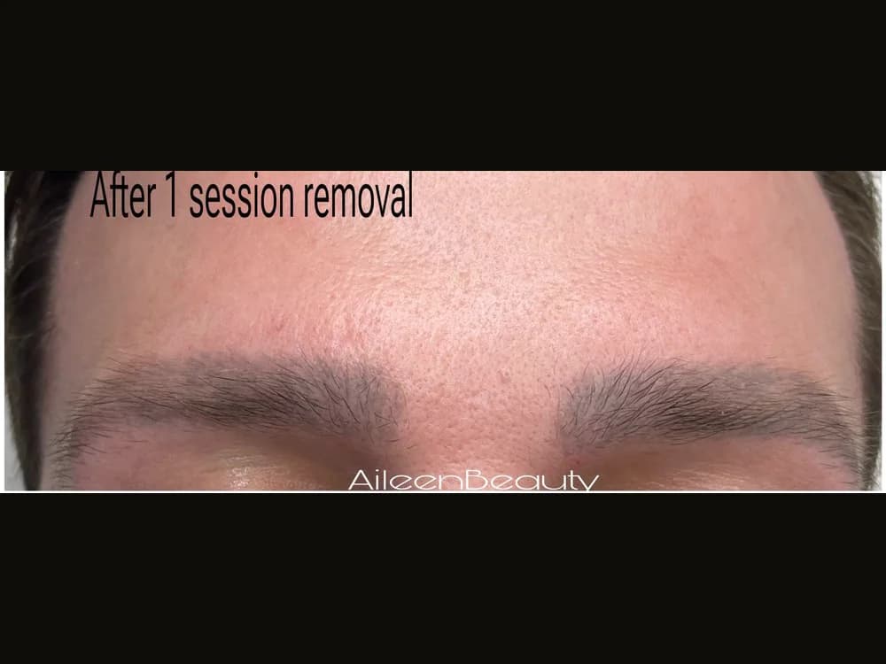 The same client after non-laser eyebrow tattoo removal at Aileen's Beauty — dark / cool pigment visibly lifted