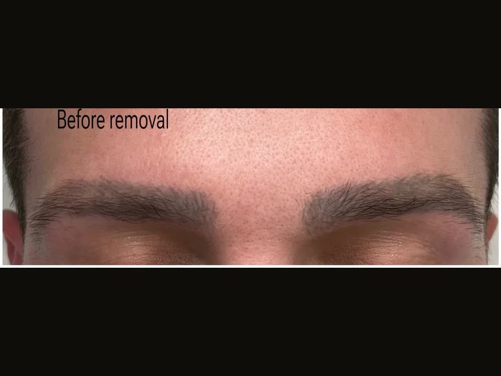 Real client with dark / cool dark brow tattoo (male client) before non-laser eyebrow tattoo removal at Aileen's Beauty in Campbell, California
