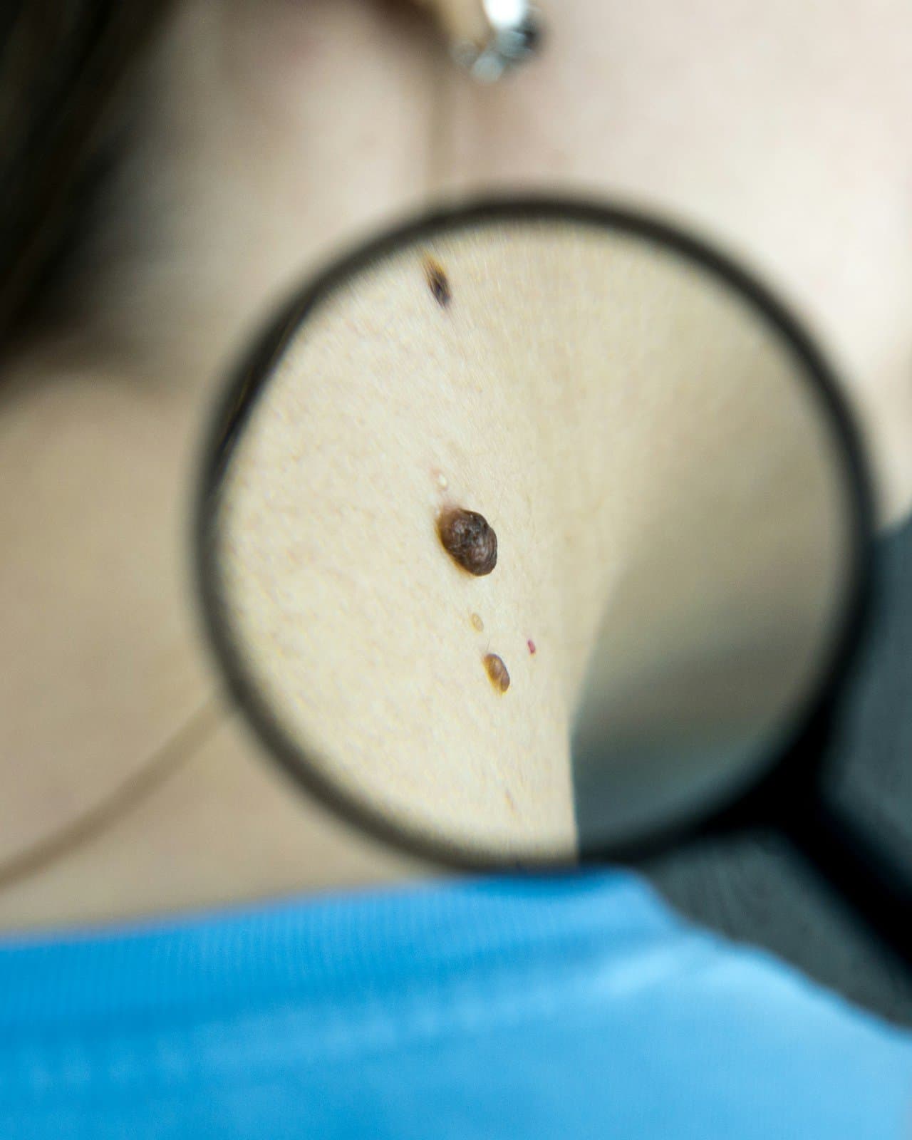 Skin Tag Removal