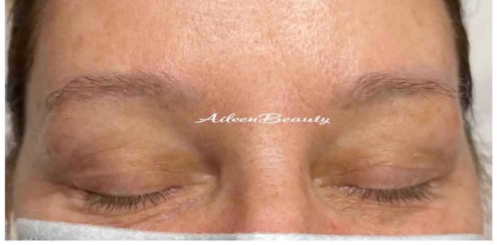 The same client after non-laser eyebrow tattoo removal at Aileen's Beauty — gray / blue pigment visibly lifted