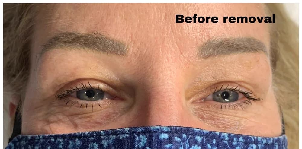 Real client with gray / blue cool-shifted microblading before non-laser eyebrow tattoo removal at Aileen's Beauty in Campbell, California